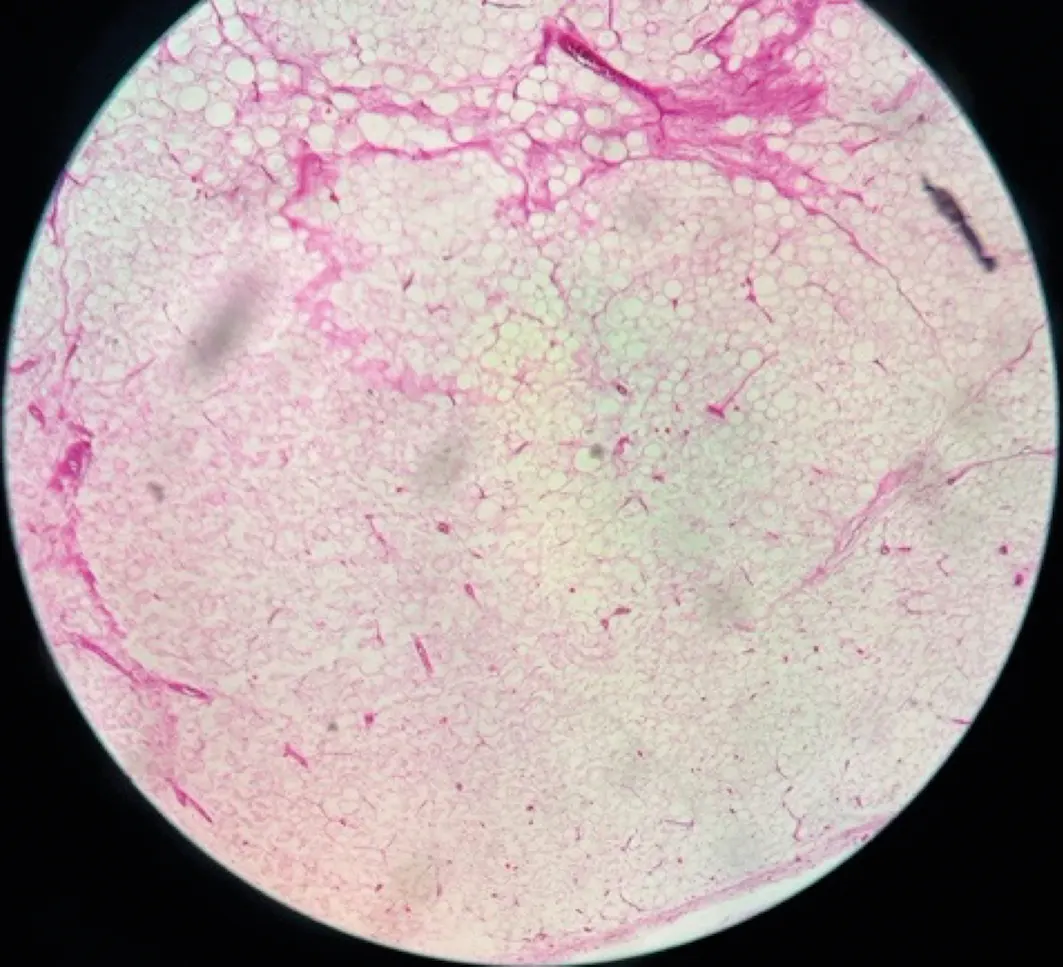 Lipoma mixoide testicular en paciente de 72 años - Revista Indexia