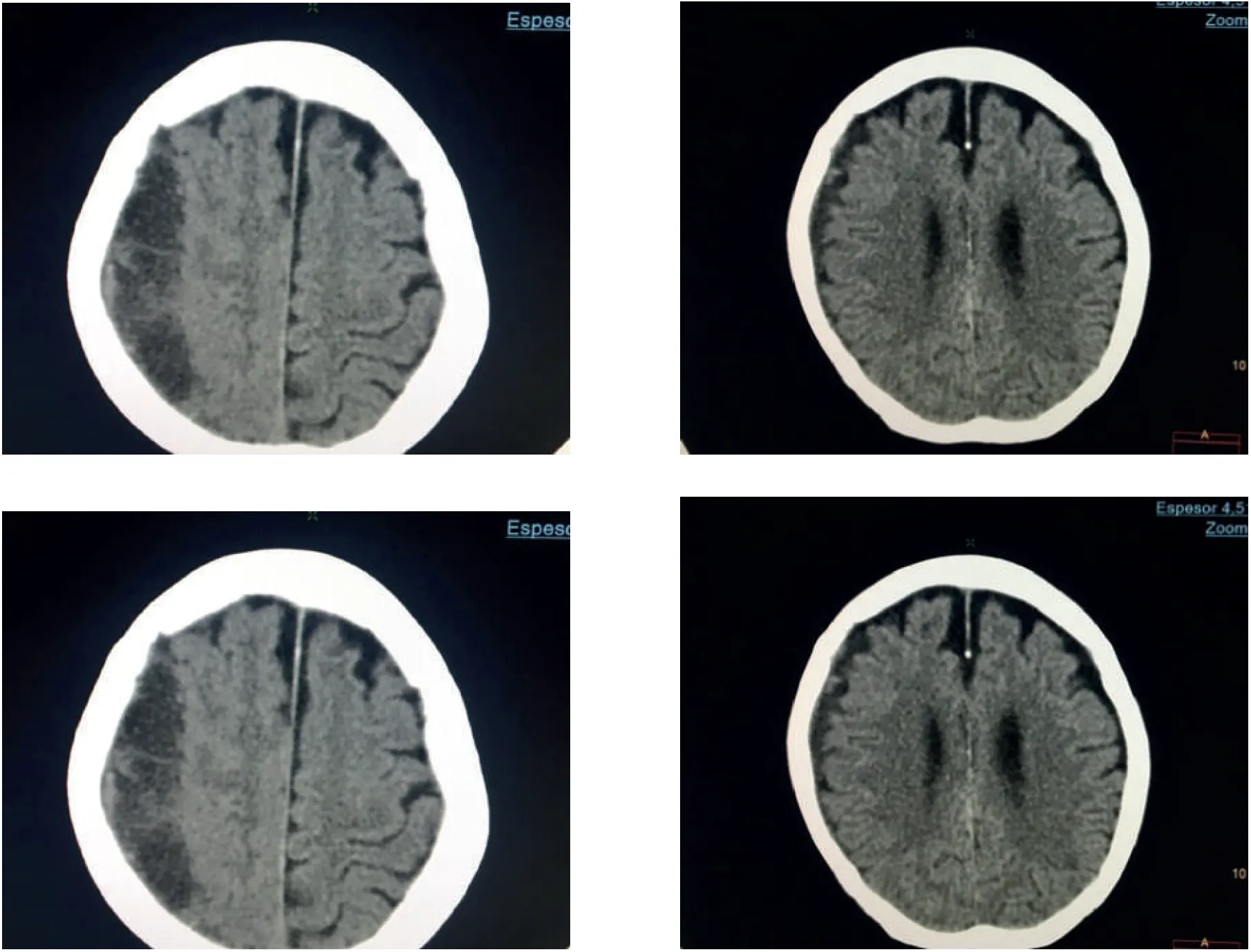 Hematoma subdural crónico, tratamiento clínico