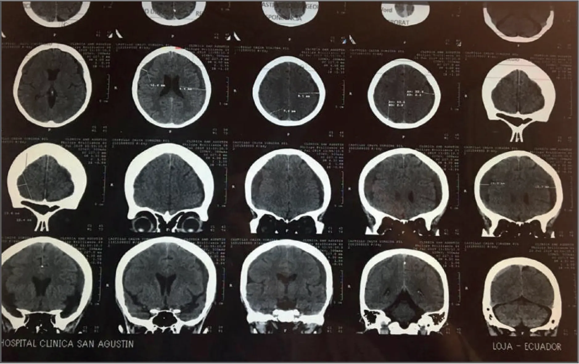 Hematoma subdural crónico, tratamiento clínico