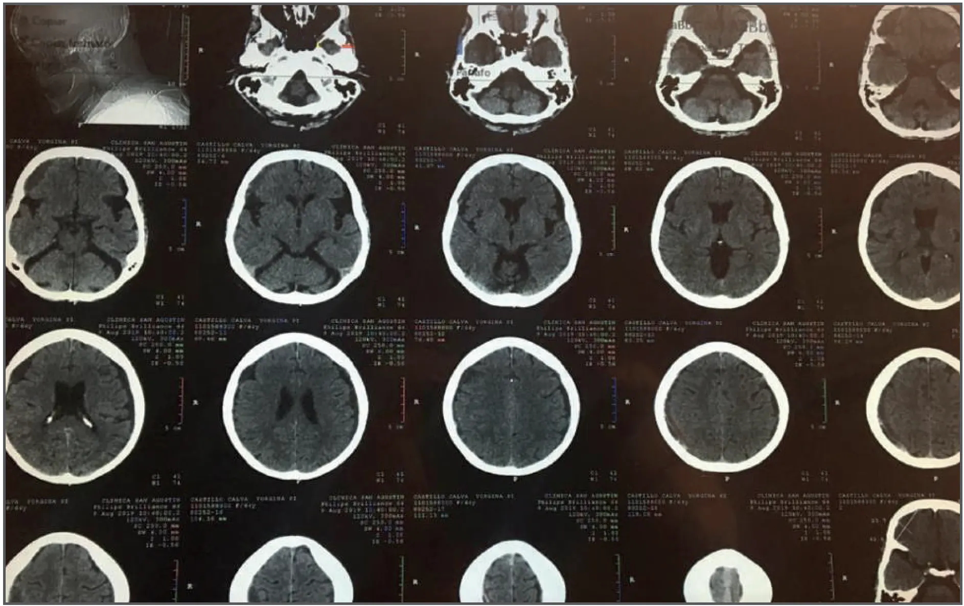 Hematoma subdural crónico, tratamiento clínico