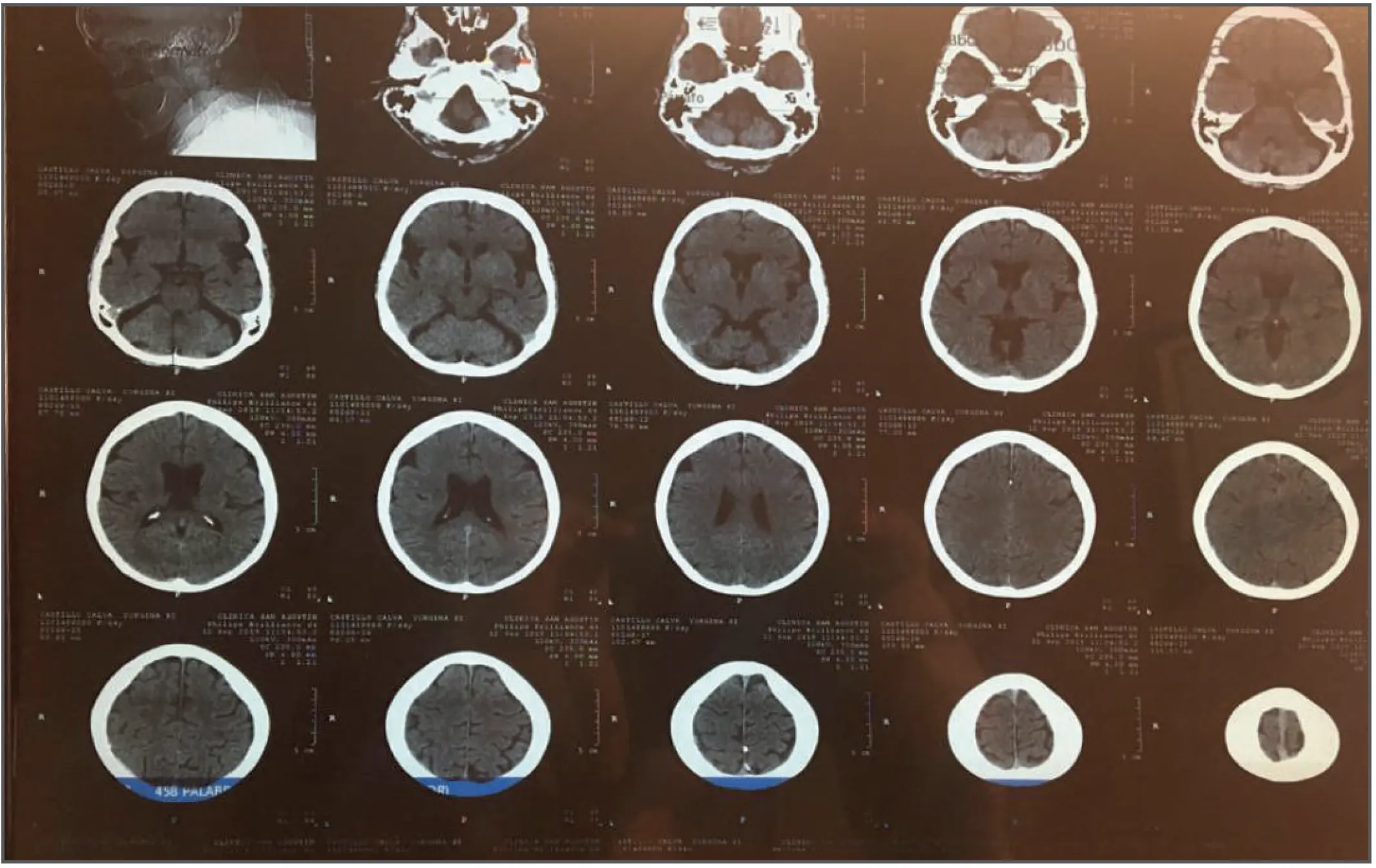 Hematoma subdural crónico, tratamiento clínico