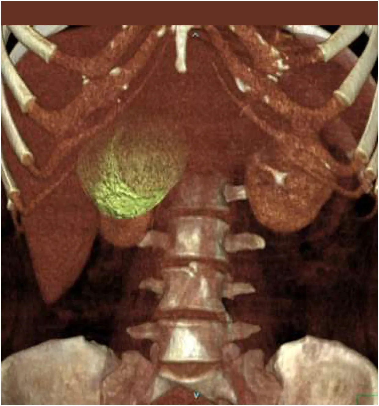 Quiste subhepático no infeccioso compresivo. Diagnóstico y tratamiento mínimamente invasivo