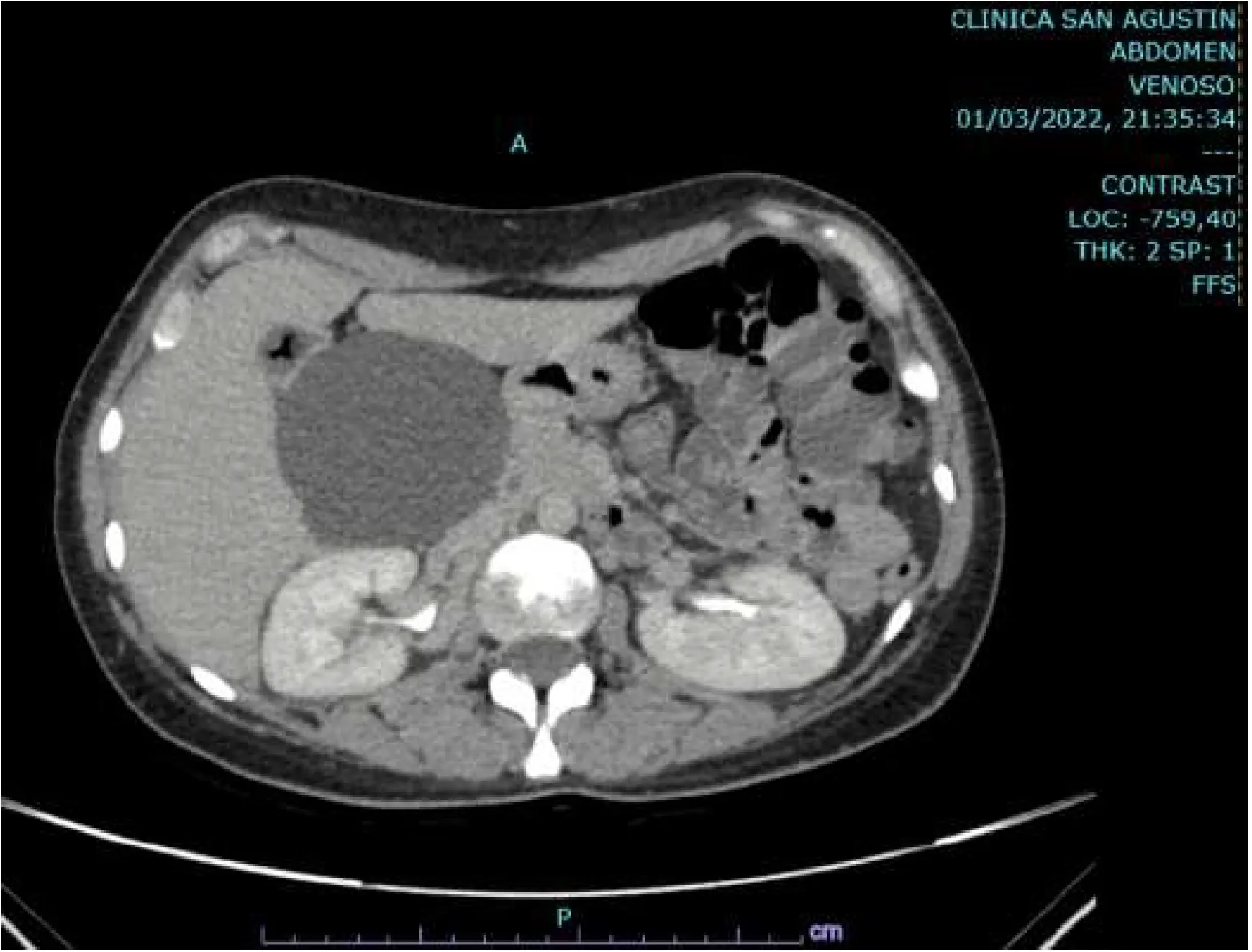 Quiste subhepático no infeccioso compresivo. Diagnóstico y tratamiento mínimamente invasivo