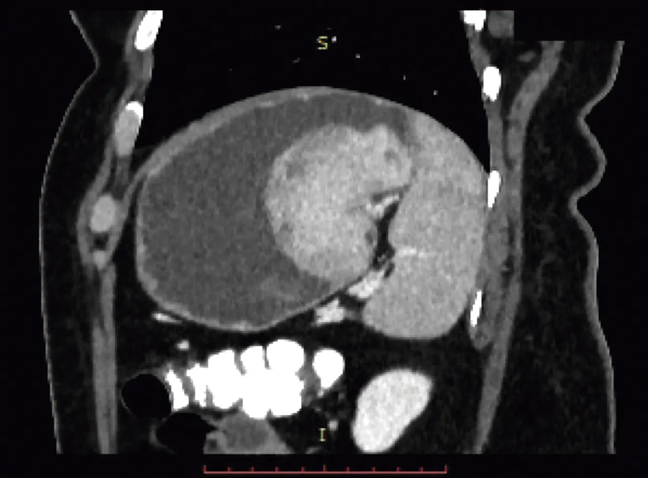 tumor mio broblastico in amatorio gastrico 3