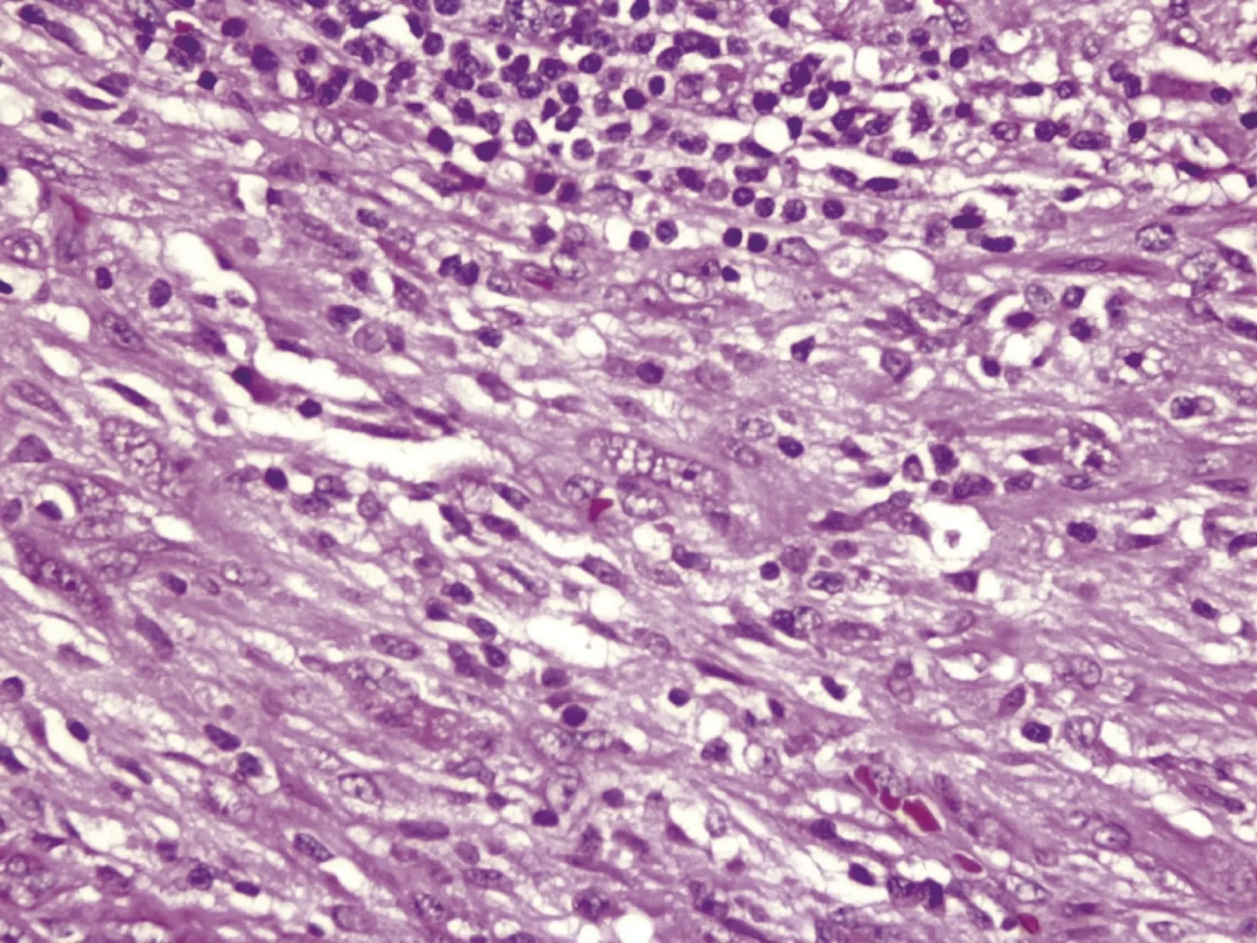 tumor mio broblastico in amatorio gastrico 5