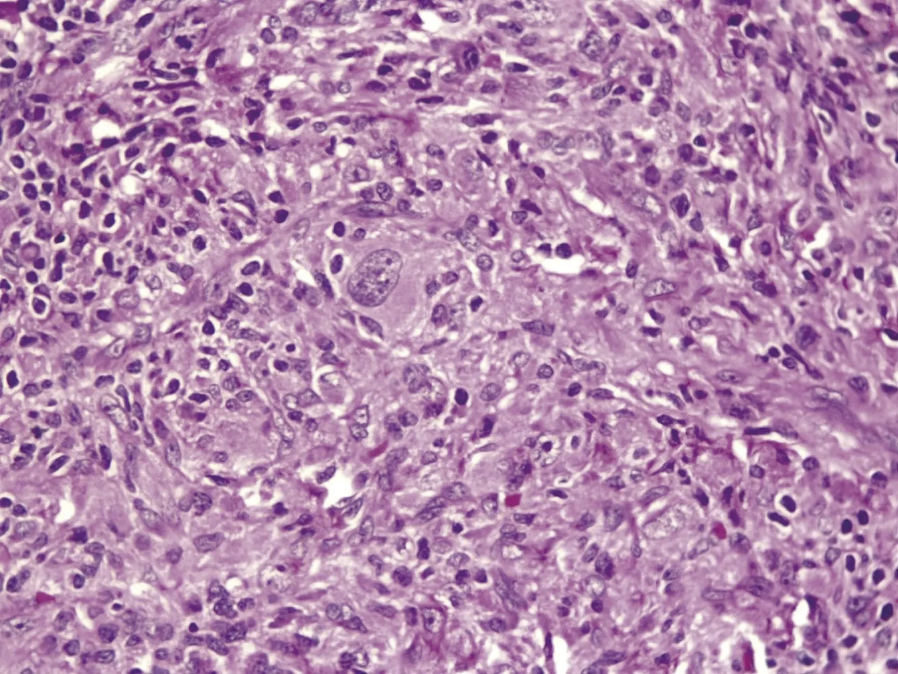 tumor mio broblastico in amatorio gastrico 6