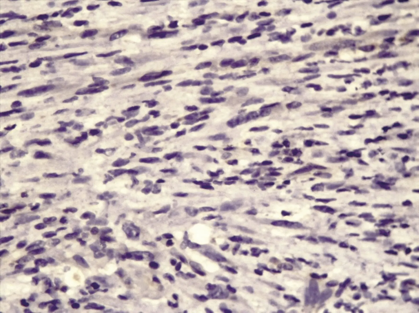 tumor mio broblastico in amatorio gastrico 8