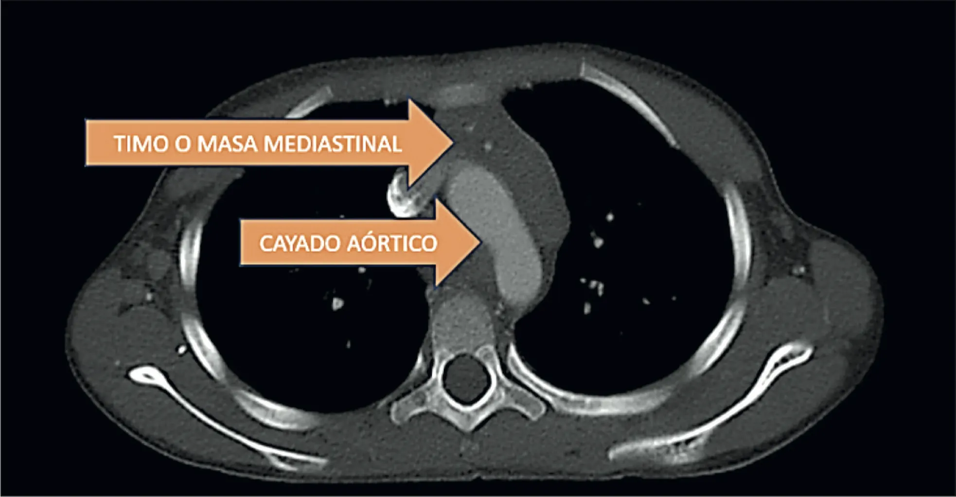 Linfoma de Hodgkin clásico celularidad-mixta