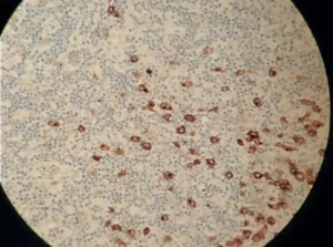 Linfoma de Hodgkin clásico celularidad-mixta