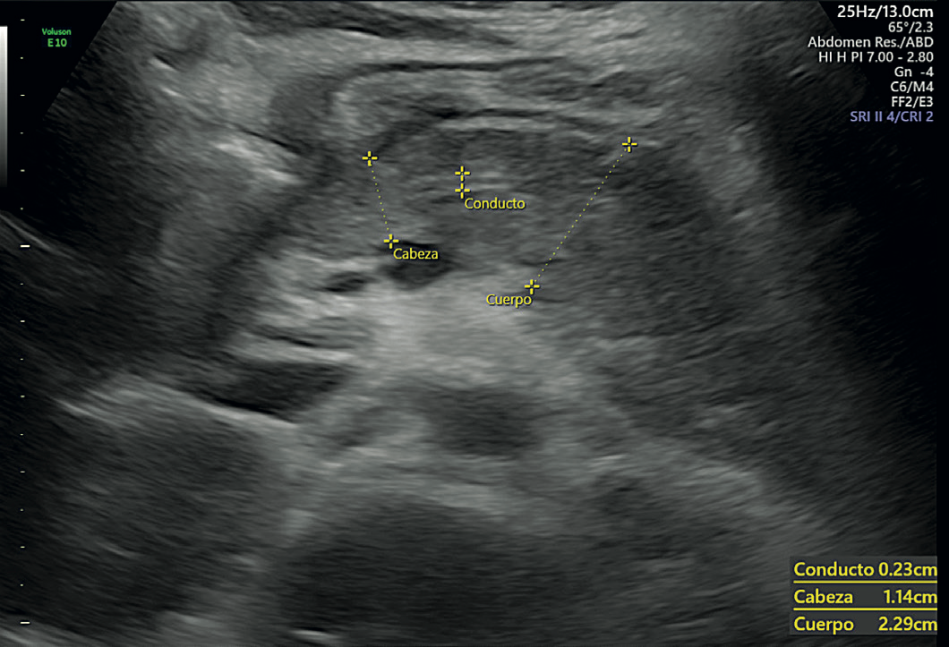 pancreatitis en nina con tratamiento anticonvulsivante 2