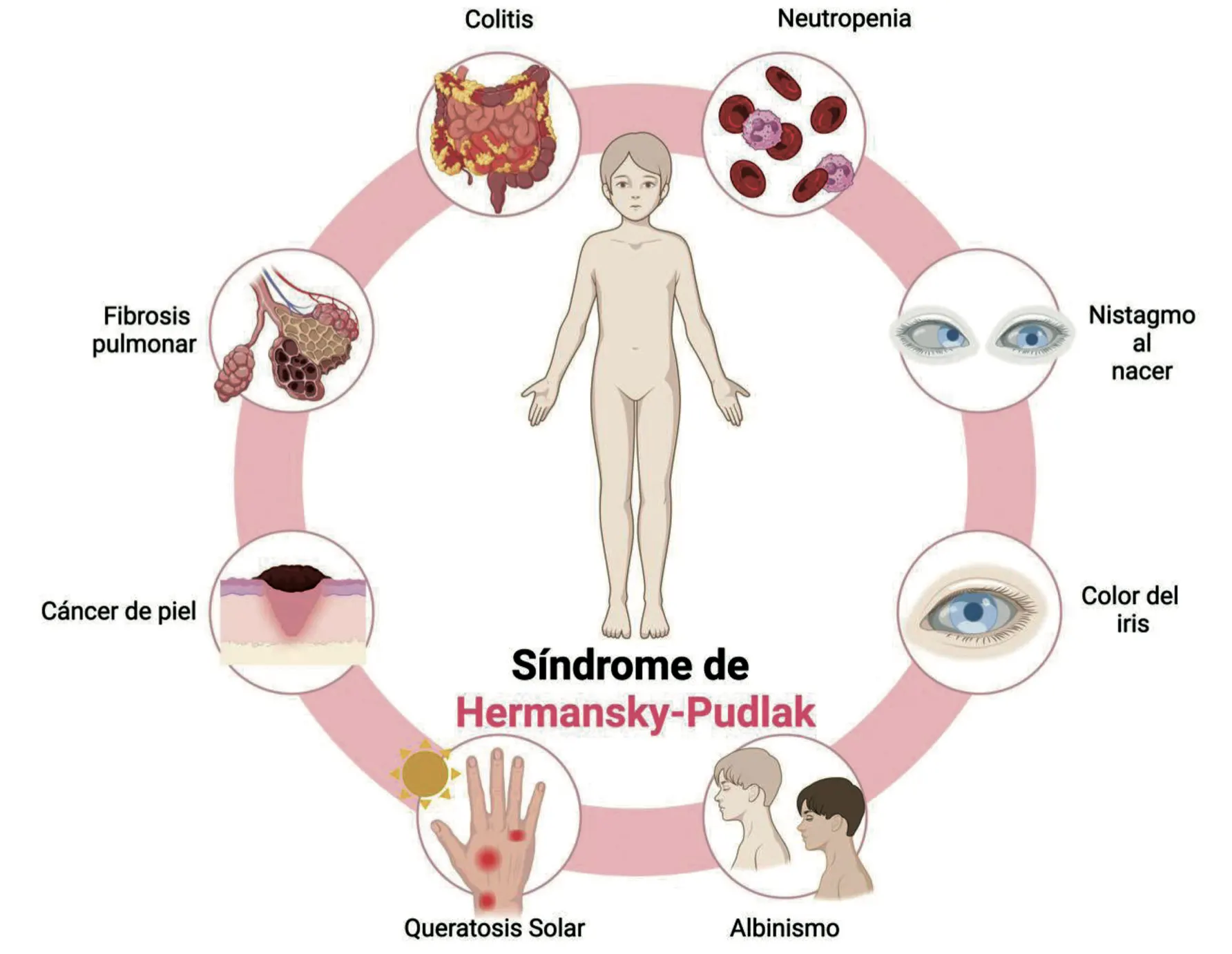 Síndrome de Hermansky-Pudlak y sus mecanismos genéticos y fisiopatológicos